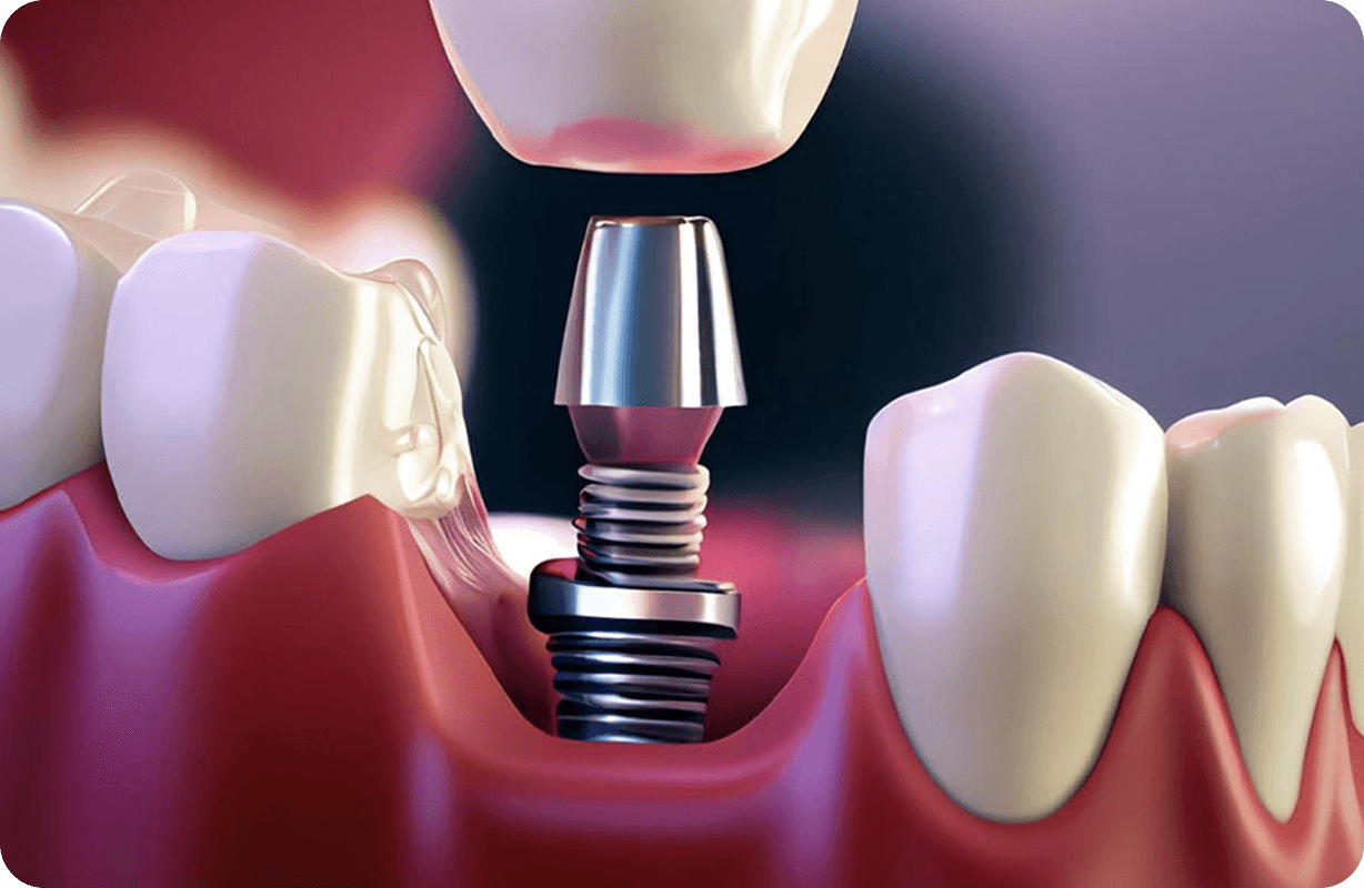 Dental Implants