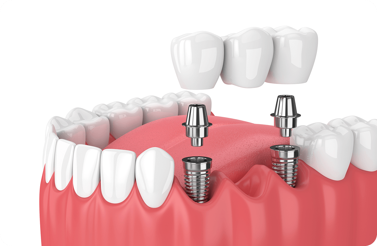 Dental bridges