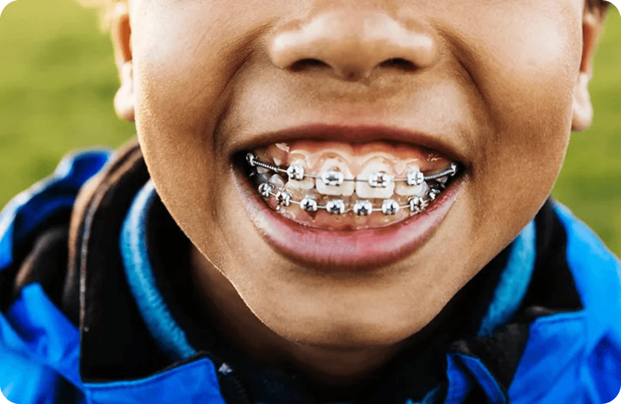 teeth with braces
